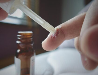 Warts