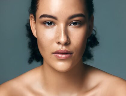 Melasma