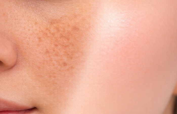 Close-up skin texture concept showing uneven pigmentation blending into more even tone