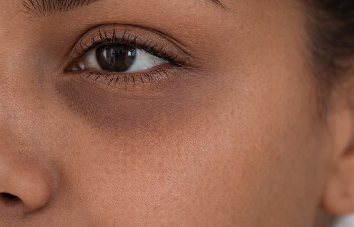 Brownish pigmented dark circles under the eyes in medium skin tone