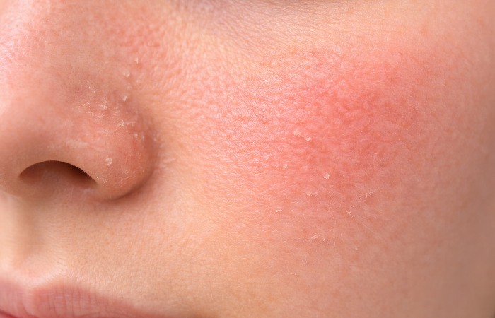 Close-up of facial skin showing mild redness and dryness to illustrate sensitivity risk