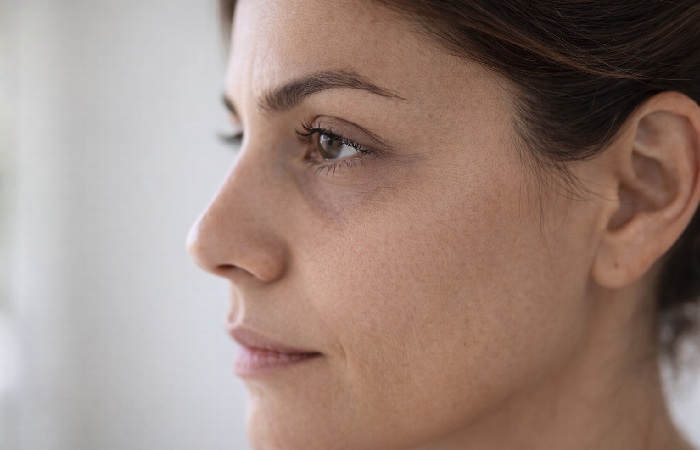 Side profile showing tear trough hollow causing shadow under the eye