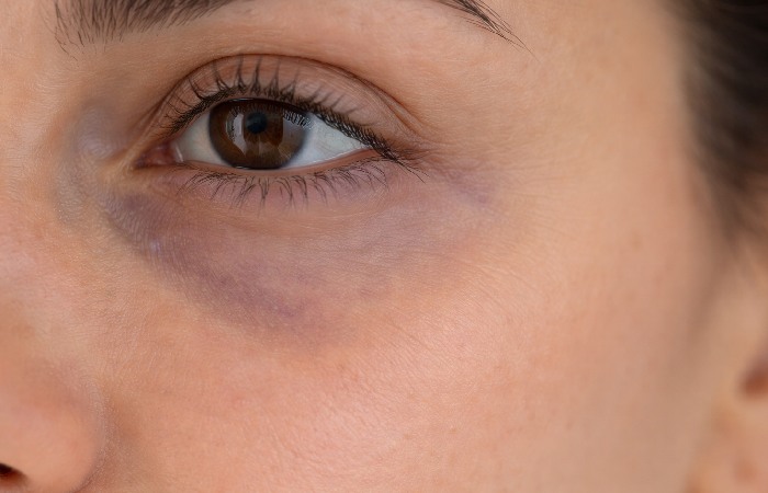 Close-up of thin under-eye skin with visible bluish vascular tone
