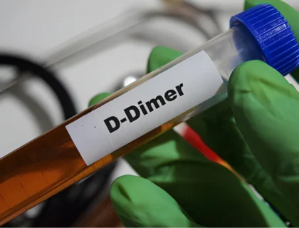 d-dimer testing