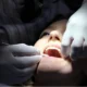 dental crowns