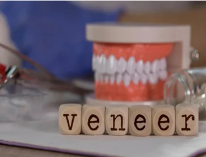 dental veneers